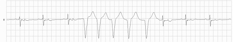 Idioventricular Rhythm Rhythm Strip